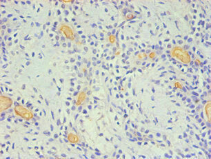 Immunohistochemical of paraffin-embedded Human breast cancer using the antibody (2E11-2B5) at dilution of 1:200.