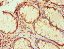 Immunohistochemical of paraffin-embedded human colon cancer using PLA2G7 Monoclonal Antibody at dilution of 1:200.