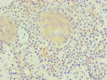 Immunohistochemical of paraffin-embedded human breast cancer using PLA2G7 Monoclonal Antibody at dilution of 1:200.