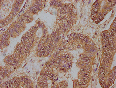 IHC image of PD-L1 Monoclonal Antibody diluted at 1:100 and staining in paraffin-embedded human colon cancer performed on a Leica BondTM system. After dewaxing and hydration, antigen retrieval was mediated by high pressure in a citrate buffer (pH 6.0). Section was blocked with 10% normal goat serum 30min at RT. Then primary antibody (1% BSA) was incubated at 4°C overnight. The primary is detected by a biotinylated secondary antibody and visualized using an HRP conjugated SP system.