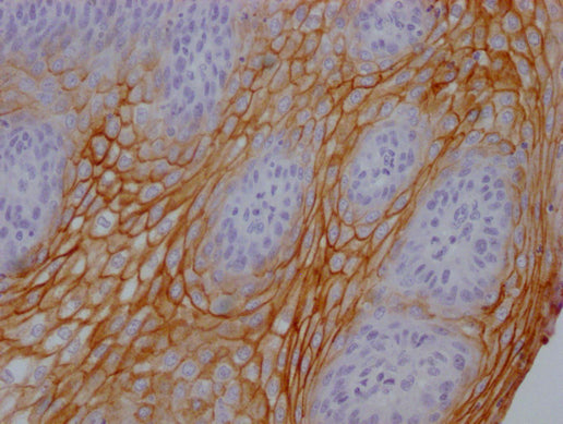 IHC image of the antibody diluted at 1:100 and staining in paraffin-embedded human tonsil tissue performed on a Leica BondTM system. After dewaxing and hydration, antigen retrieval was mediated by high pressure in a citrate buffer (pH 6.0). Section was blocked with 10% normal goat serum 30min at RT. Then primary antibody (1% BSA) was incubated at 4°C overnight. The primary is detected by a Goat anti-mouse IgG polymer labeled by HRP and visualized using 0.05% DAB.