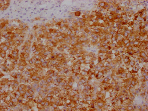 IHC image of CEACAM5 Monoclonal Antibody diluted at 1:100 and staining in paraffin-embedded human colon cancer performed on a Leica BondTM system. After dewaxing and hydration, antigen retrieval was mediated by high pressure in a citrate buffer (pH 6.0). Section was blocked with 10% normal goat serum 30min at RT. Then primary antibody (1% BSA) was incubated at 4°C overnight. The primary is detected by a Goat anti-mouse IgG polymer labeled by HRP and visualized using 0.05% DAB.