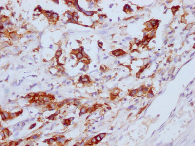 IHC image of CEACAM5 Monoclonal Antibody diluted at 1:100 and staining in paraffin-embedded human gastric cancer performed on a Leica BondTM system. After dewaxing and hydration, antigen retrieval was mediated by high pressure in a citrate buffer (pH 6.0). Section was blocked with 10% normal goat serum 30min at RT. Then primary antibody (1% BSA) was incubated at 4°C overnight. The primary is detected by a Goat anti-mouse IgG polymer labeled by HRP and visualized using 0.05% DAB.