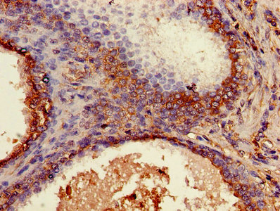 Immunohistochemistry of paraffin-embedded human prostate cancer using B2M Antibody at dilution of 1:100