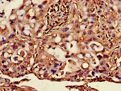 Immunohistochemistry of paraffin-embedded human lung cancer using B2M Antibody at dilution of 1:100