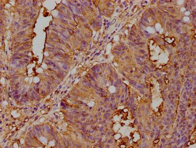 IHC image of the antibody diluted at 1:400 and staining in paraffin-embedded human colon cancer performed on a Leica BondTM system. After dewaxing and hydration, antigen retrieval was mediated by high pressure in a citrate buffer (pH 6.0). Section was blocked with 10% normal goat serum 30min at RT. Then primary antibody (1% BSA) was incubated at 4°C overnight. The primary is detected by a biotinylated secondary antibody and visualized using an HRP conjugated SP system.