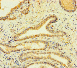 Immunohistochemistry of paraffin-embedded human prostate cancer using the antibody at dilution of 1:100