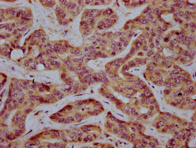 IHC image of the antibody diluted at 1:400 and staining in paraffin-embedded human liver cancer performed on a Leica BondTM system. After dewaxing and hydration, antigen retrieval was mediated by high pressure in a citrate buffer (pH 6.0). Section was blocked with 10% normal goat serum 30min at RT. Then primary antibody (1% BSA) was incubated at 4°C overnight. The primary is detected by a biotinylated secondary antibody and visualized using an HRP conjugated SP system.