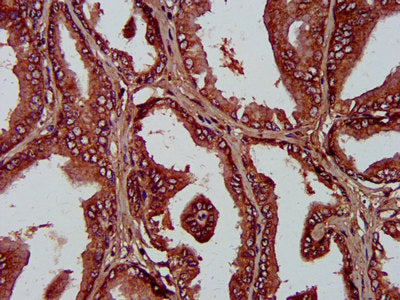 IHC image of PLA1A Antibody diluted at 1:400 and staining in paraffin-embedded human prostate tissue performed on a Leica BondTM system. After dewaxing and hydration, antigen retrieval was mediated by high pressure in a citrate buffer (pH 6.0). Section was blocked with 10% normal goat serum 30min at RT. Then primary antibody (1% BSA) was incubated at 4°C overnight. The primary is detected by a biotinylated secondary antibody and visualized using an HRP conjugated SP system.