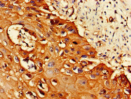 Immunohistochemistry of paraffin-embedded human cervical cancer using PSMA1 Antibody at dilution of 1:100