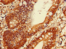 Immunohistochemistry of paraffin-embedded human colon cancer using PSMA1 Antibody at dilution of 1:100