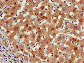 Immunohistochemistry of paraffin-embedded human liver cancer using PSMA5 Antibody at dilution of 1:100