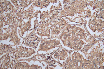 IHC image of the antibody diluted at 1:200 and staining in paraffin-embedded human lung cancer performed on a Leica BondTM system. After dewaxing and hydration, antigen retrieval was mediated by high pressure in a citrate buffer (pH 6.0). Section was blocked with 10% normal goat serum 30min at RT. Then primary antibody (1% BSA) was incubated at 4°C overnight. The primary is detected by a Goat anti-rabbit polymer IgG labeled by HRP and visualized using 0.05% DAB.