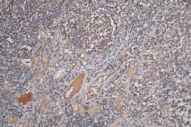 IHC image of SLAMF7 Antibody diluted at 1:200 and staining in paraffin-embedded human lymph node tissue performed on a Leica BondTM system. After dewaxing and hydration, antigen retrieval was mediated by high pressure in a citrate buffer (pH 6.0). Section was blocked with 10% normal goat serum 30min at RT. Then primary antibody (1% BSA) was incubated at 4°C overnight. The primary is detected by a Goat anti-rabbit polymer IgG labeled by HRP and visualized using 0.05% DAB.