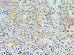 Immunohistochemistry of paraffin-embedded human breast cancer using TNFSF13 Antibody at dilution of 1:100