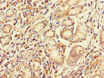 Immunohistochemistry of paraffin-embedded human gastric cancer using FCGR2A Antibody at dilution of 1:100