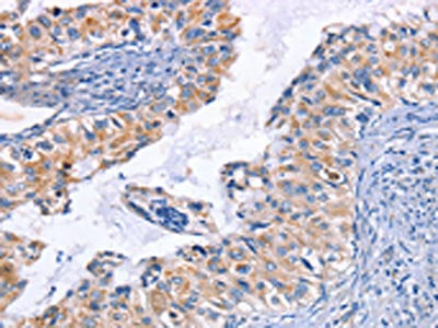 The image on the left is immunohistochemistry of paraffin-embedded Human cervical cancer tissue using CD48 Antibody(CD48 Antibody) at dilution 1/50, on the right is treated with synthetic peptide. (Original magnification: ×200)