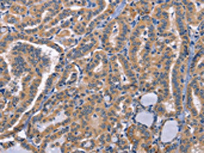 The image on the left is immunohistochemistry of paraffin-embedded Human thyroid cancer tissue using the antibody Antibody) at dilution 1/50, on the right is treated with synthetic peptide. (Original magnification: ×200)