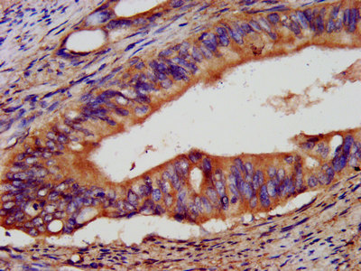 IHC image of EPCAM Antibody diluted at 1:400 and staining in paraffin-embedded human colon cancer performed on a Leica BondTM system. After dewaxing and hydration, antigen retrieval was mediated by high pressure in a citrate buffer (pH 6.0). Section was blocked with 10% normal goat serum 30min at RT. Then primary antibody (1% BSA) was incubated at 4°C overnight. The primary is detected by a biotinylated secondary antibody and visualized using an HRP conjugated SP system.