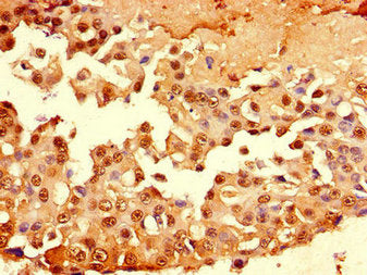 Immunohistochemistry of paraffin-embedded human breast cancer using the antibody at dilution of 1:100