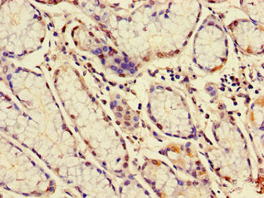 Immunohistochemistry of paraffin-embedded human gastric cancer using MUC1 Antibody at dilution of 1:100