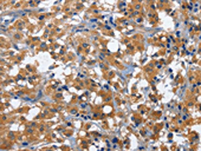 The image on the left is immunohistochemistry of paraffin-embedded Human thyroid cancer tissue using CD27 Antibody(CD27 Antibody) at dilution 1/60, on the right is treated with fusion protein. (Original magnification: ×200)