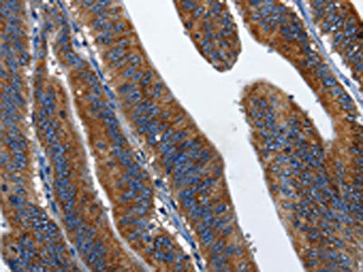 The image on the left is immunohistochemistry of paraffin-embedded Human colon cancer tissue using the antibody Antibody) at dilution 1/60, on the right is treated with fusion protein. (Original magnification: ×200)