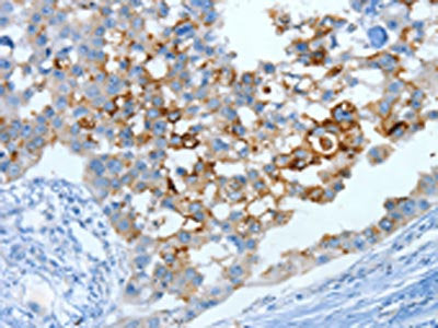 The image on the left is immunohistochemistry of paraffin-embedded Human breast cancer tissue using MUC15 Antibody(MUC15 Antibody) at dilution 1/25, on the right is treated with fusion protein. (Original magnification: ×200)