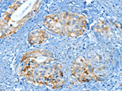 The image on the left is immunohistochemistry of paraffin-embedded Human cervical cancer tissue using the antibody Antibody) at dilution 1/25, on the right is treated with fusion protein. (Original magnification: ×200)