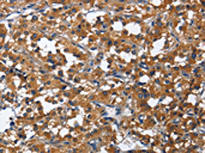 The image on the left is immunohistochemistry of paraffin-embedded Human thyroid cancer tissue using the antibody Antibody) at dilution 1/60, on the right is treated with fusion protein. (Original magnification: ×200)