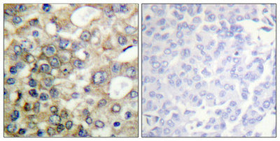 Immunohistochemical analysis of paraffin-embedded human breast carcinoma tissue using CD227/MUC1 (Phospho-Tyr1229) antibody (left)or the same antibody preincubated with blocking peptide (right).