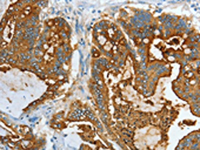 The image on the left is immunohistochemistry of paraffin-embedded Human colon cancer tissue using CEACAM5 Antibody(CEACAM5 Antibody) at dilution 1/20, on the right is treated with fusion protein. (Original magnification: ×200)