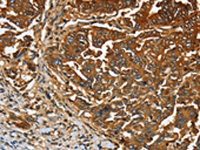 The image on the left is immunohistochemistry of paraffin-embedded Human gastic cancer tissue using the antibody Antibody) at dilution 1/20, on the right is treated with fusion protein. (Original magnification: ×200)