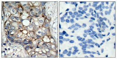 Immunohistochemical analysis of paraffin-embedded human breast carcinoma tissue using EGFR(Ab-1070) Antibody(left) or the same antibody preincubated with blocking peptide(right).