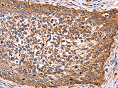 The image on the left is immunohistochemistry of paraffin-embedded Human cervical cancer tissue using AMIGO2 Antibody(AMIGO2 Antibody) at dilution 1/50, on the right is treated with fusion protein. (Original magnification: ×200)