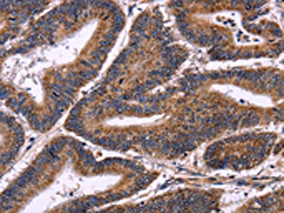 The image on the left is immunohistochemistry of paraffin-embedded Human colon cancer tissue using the antibody Antibody) at dilution 1/50, on the right is treated with fusion protein. (Original magnification: ×200)