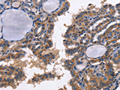 The image on the left is immunohistochemistry of paraffin-embedded Human thyroid cancer tissue using CD48 Antibody(CD48 Antibody) at dilution 1/40, on the right is treated with synthetic peptide. (Original magnification: ×200)