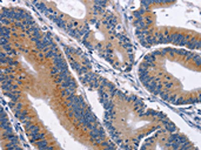 The image on the left is immunohistochemistry of paraffin-embedded Human colon cancer tissue using the antibody Antibody) at dilution 1/40, on the right is treated with synthetic peptide. (Original magnification: ×200)