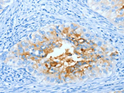 The image on the left is immunohistochemistry of paraffin-embedded Human cervical cancer tissue using CEACAM5 Antibody(CEACAM5 Antibody) at dilution 1/20, on the right is treated with fusion protein. (Original magnification: ×200)