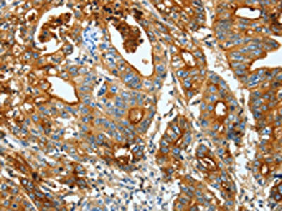 The image on the left is immunohistochemistry of paraffin-embedded Human gastic cancer tissue using the antibody Antibody) at dilution 1/20, on the right is treated with fusion protein. (Original magnification: ×200)