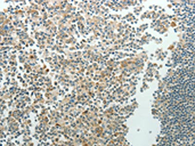 The image on the left is immunohistochemistry of paraffin-embedded Human tonsil tissue using the antibody Antibody) at dilution 1/70, on the right is treated with synthetic peptide. (Original magnification: ×200)