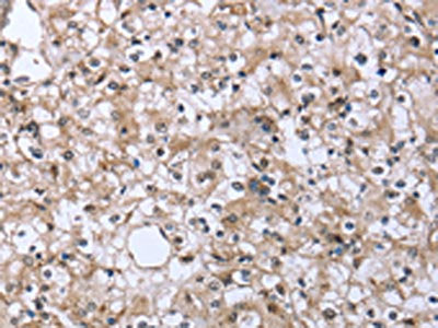 The image on the left is immunohistochemistry of paraffin-embedded Human prostate cancer tissue using FCAR Antibody(FCAR Antibody) at dilution 1/20, on the right is treated with fusion protein. (Original magnification: ×200)