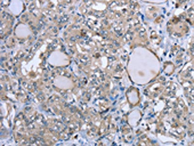 The image on the left is immunohistochemistry of paraffin-embedded Human thyroid cancer tissue using the antibody Antibody) at dilution 1/20, on the right is treated with fusion protein. (Original magnification: ×200)