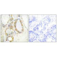 Immunohistochemistry analysis of paraffin-embedded human colon carcinoma tissue using MUC13 antibody.