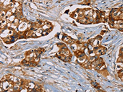 The image on the left is immunohistochemistry of paraffin-embedded Human breast cancer tissue using CD44 Antibody(CD44 Antibody) at dilution 1/35, on the right is treated with fusion protein. (Original magnification: ×200)