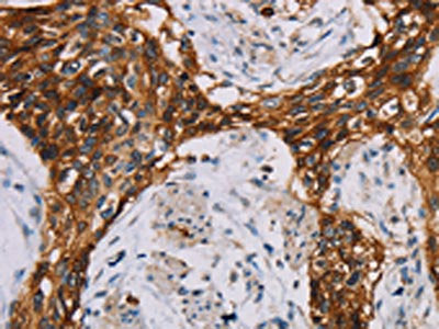 The image on the left is immunohistochemistry of paraffin-embedded Human esophagus cancer tissue using the antibody Antibody) at dilution 1/35, on the right is treated with fusion protein. (Original magnification: ×200)