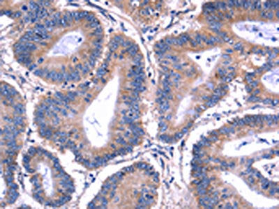 The image on the left is immunohistochemistry of paraffin-embedded Human colon cancer tissue using PVR Antibody(PVR Antibody) at dilution 1/20, on the right is treated with fusion protein. (Original magnification: ×200)