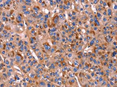 The image on the left is immunohistochemistry of paraffin-embedded Human liver cancer tissue using the antibody Antibody) at dilution 1/20, on the right is treated with fusion protein. (Original magnification: ×200)