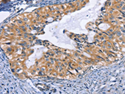 The image on the left is immunohistochemistry of paraffin-embedded Human cervical cancer tissue using CD47 Antibody(CD47 Antibody) at dilution 1/50, on the right is treated with synthetic peptide. (Original magnification: ×200)