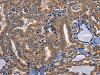 The image on the left is immunohistochemistry of paraffin-embedded Human thyroid cancer tissue using the antibody Antibody) at dilution 1/50, on the right is treated with synthetic peptide. (Original magnification: ×200)